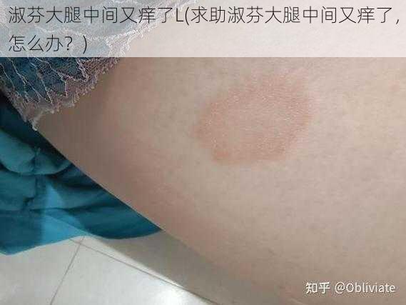 淑芬大腿中间又痒了L(求助淑芬大腿中间又痒了，怎么办？)